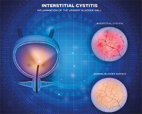 Can Mold Toxicity Cause IC & Urinary Symptoms? Yes! - Interstitial Cystitis  Network