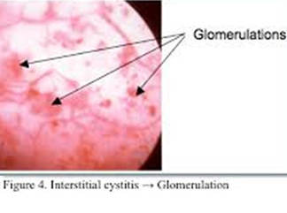 Corn Silk - Interstitial Cystitis, IC, Overactive Bladder, Kidney  Inflammation