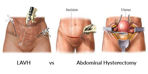 LAVH vs  Abdominal Hysterectomy