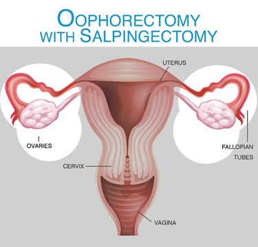 Oophorectomy