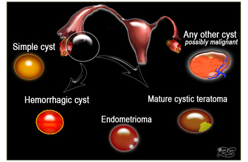 cyst