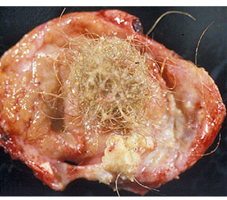 ovarian cyst with hair and teeth