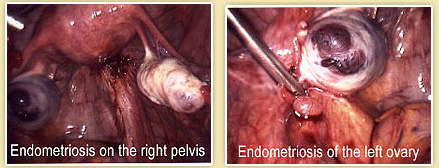 endometriosis