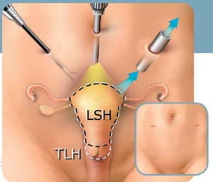 LAVH vs LSH procedure