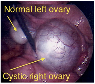 ovarian cyst with hair and teeth