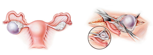 ovarian cystectomy