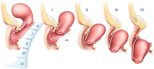 prolapse stages