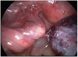 Laparoscopic resection of a torted ovarian dermoid cyst